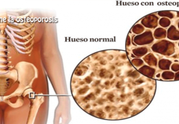 TRASTORNO EN LOS HUESOS| OSTEOPOROSIS COMO SE DIAGNOSTICA|