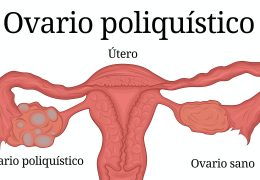 Diagnostico y Tratamiento : Síntomas del Síndrome de Ovarios Poliquísticos.
