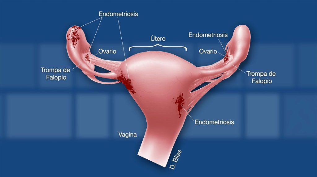 ¿ Que es endometriosis?